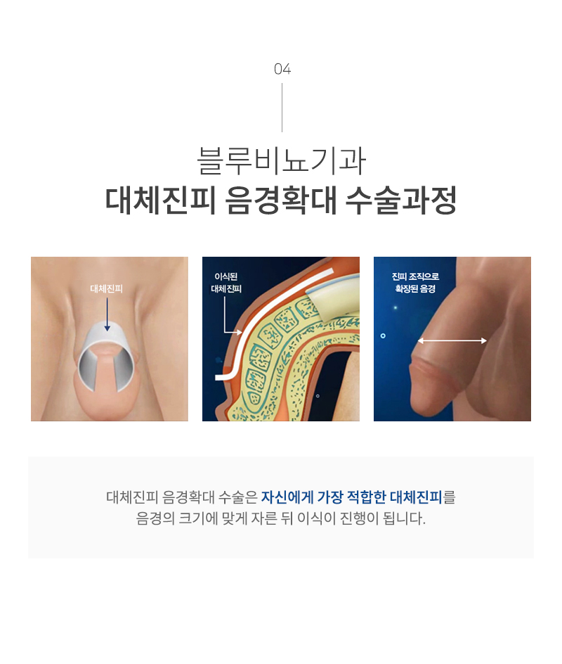 남성수술 이미지5