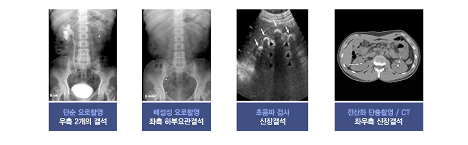 비임균성요도염 진단 참고 사진