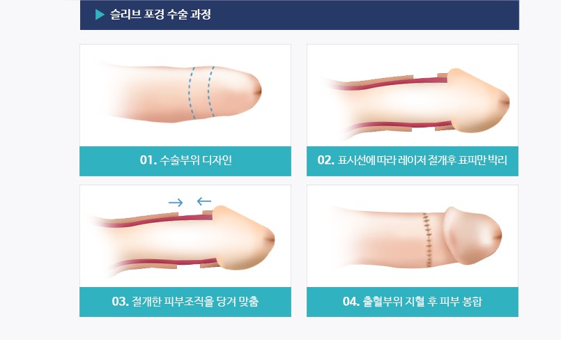 포경수술 과정