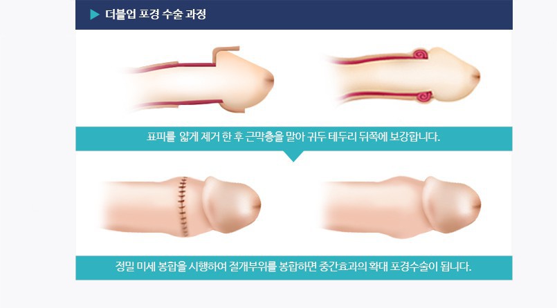 포경수술 과정